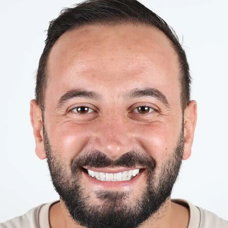 Smile makeover — After