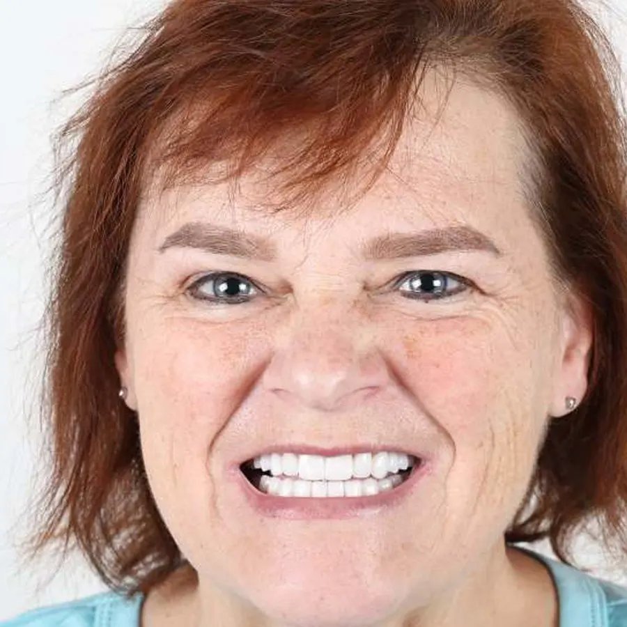 Smile makeover — After