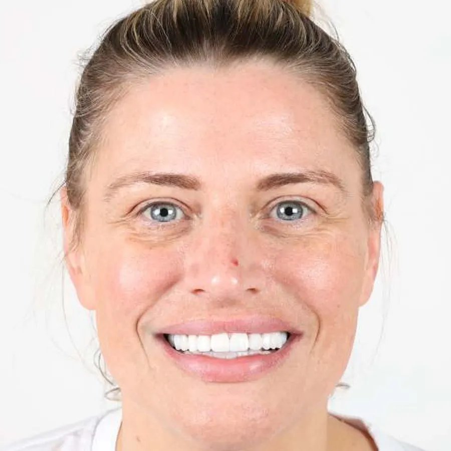 Smile makeover — After
