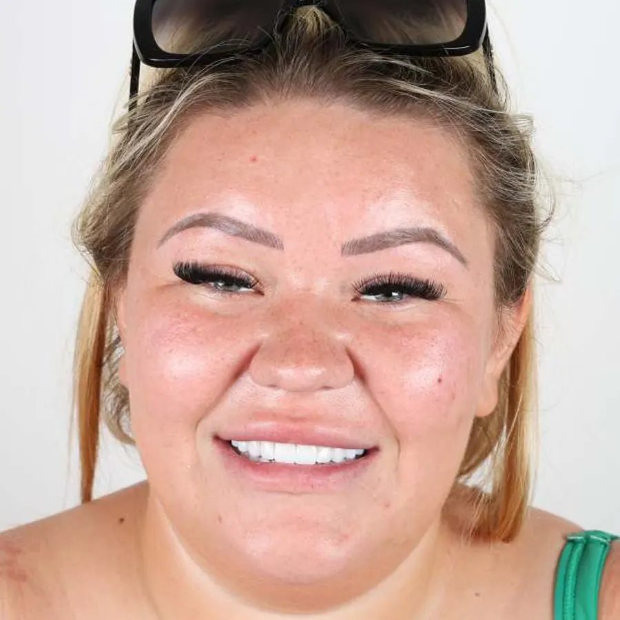 Smile makeover — After