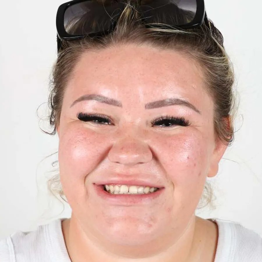 Smile makeover — Before