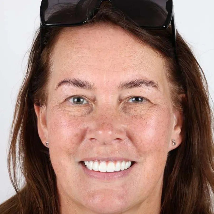 Smile makeover — After