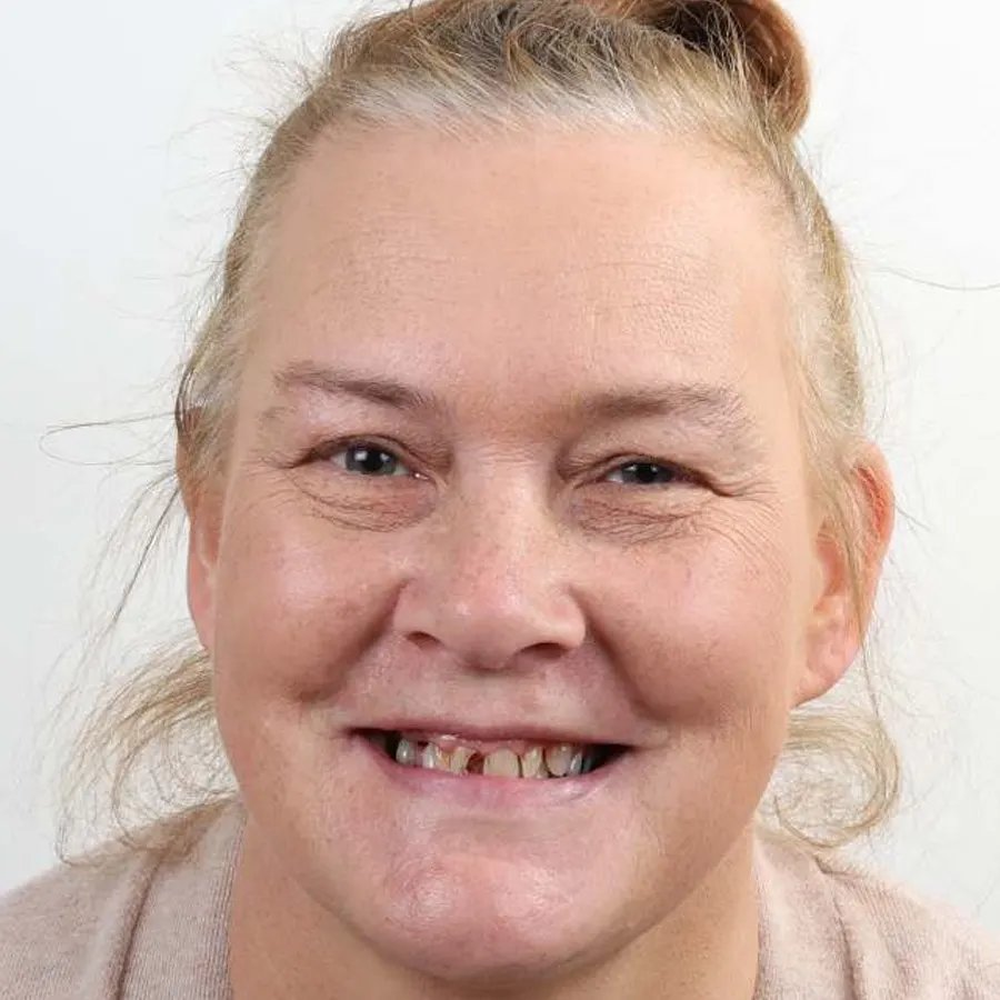 Smile makeover — Before