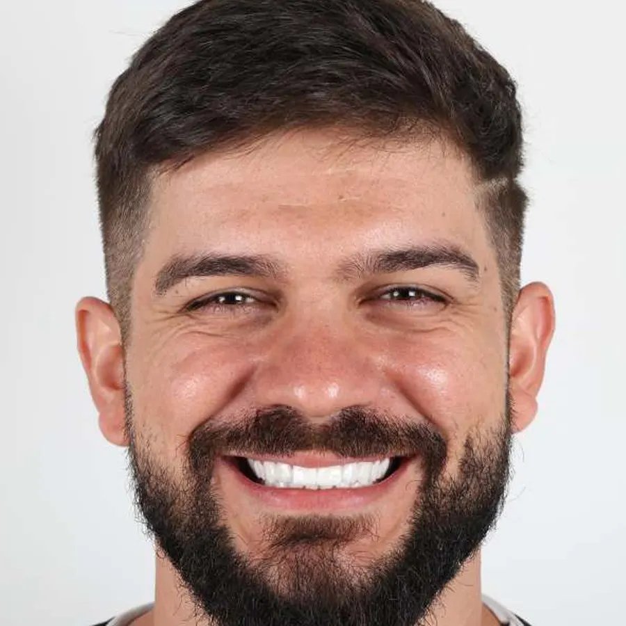 Smile makeover — After