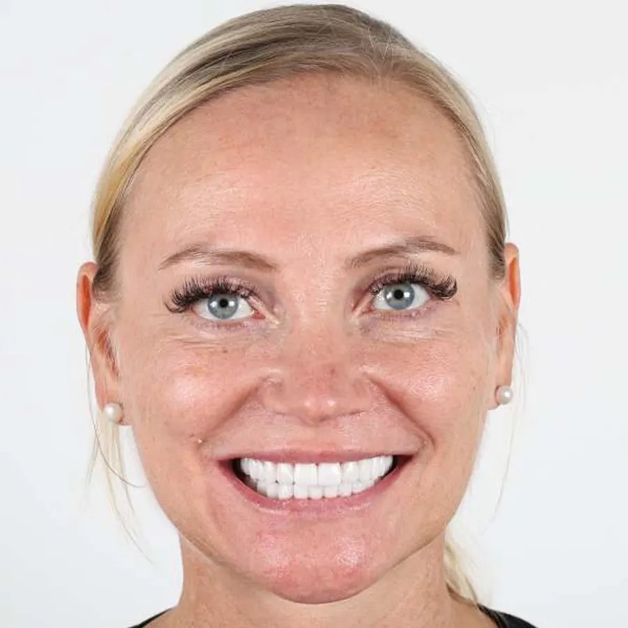 Smile makeover — After