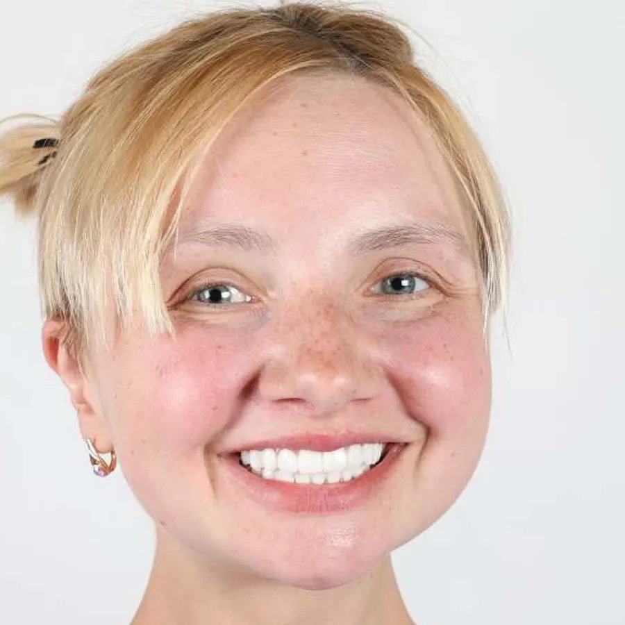 Smile makeover — After