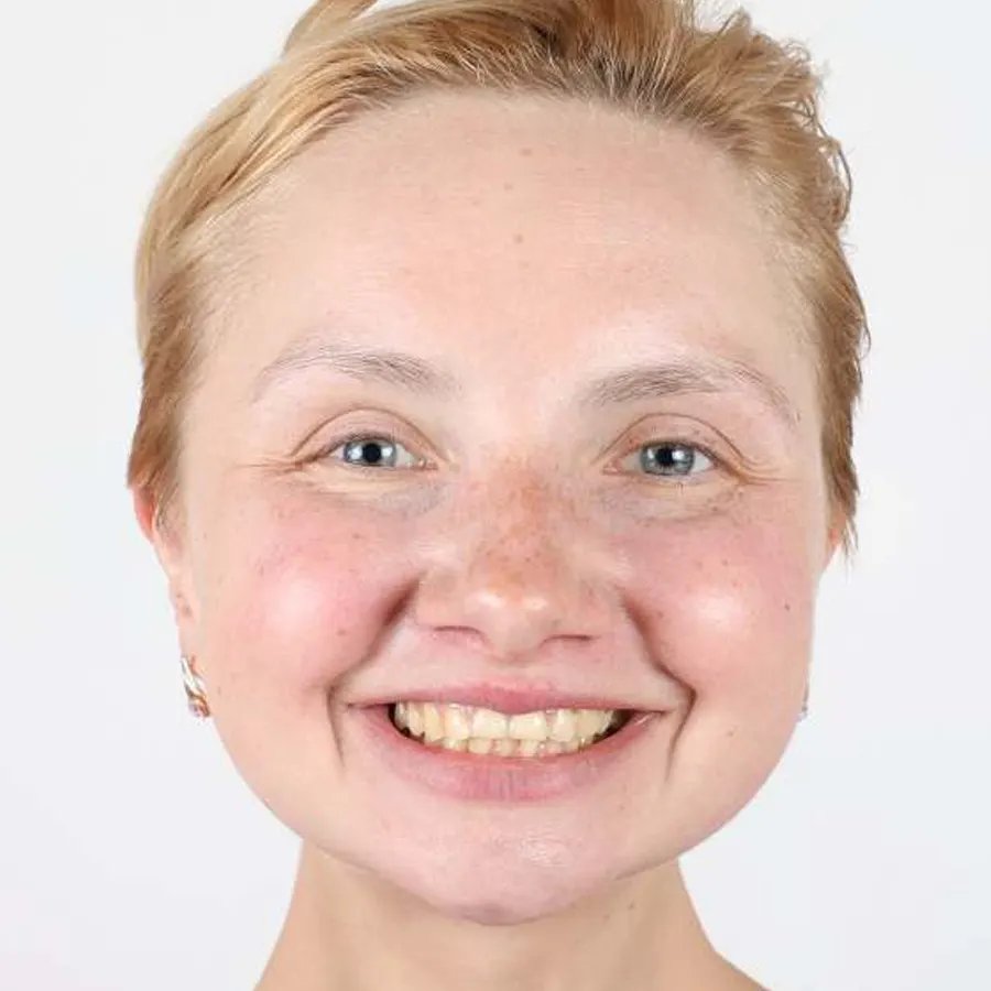 Smile makeover — Before