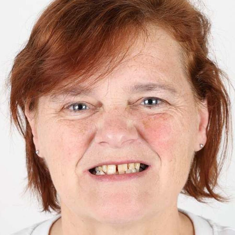 Smile makeover — Før