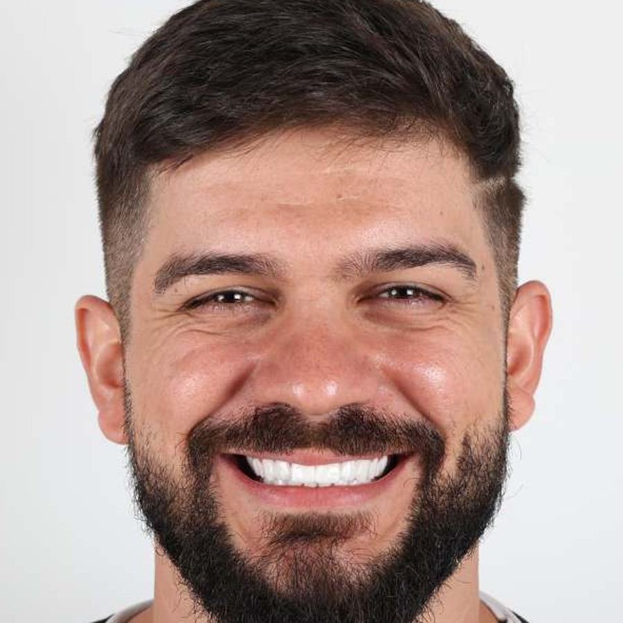 Smile makeover — Efter