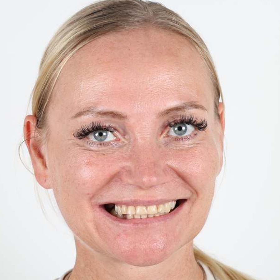 Smile makeover — Før