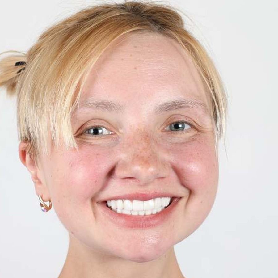 Smile makeover — Efter