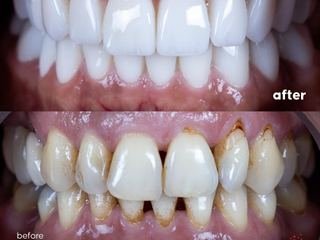 All-on-4 + zirkoniumkrone på implantat — detail