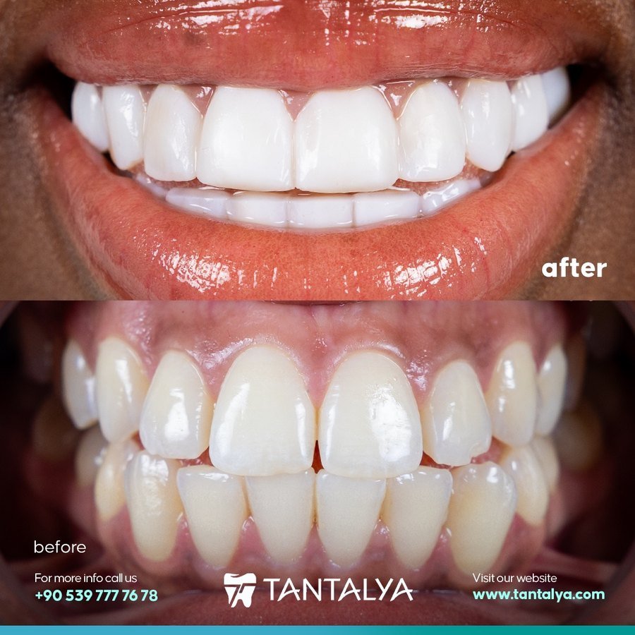 Composite veneers case — natural smile enhancement