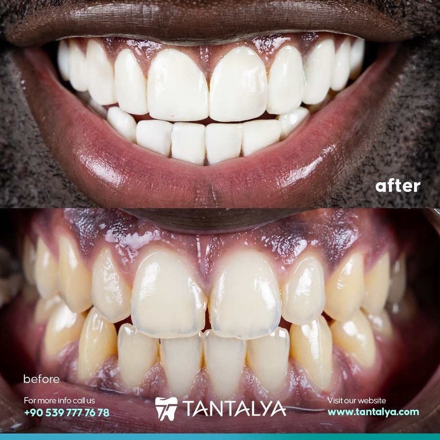 Composite veneers case — full upper arch reshaping
