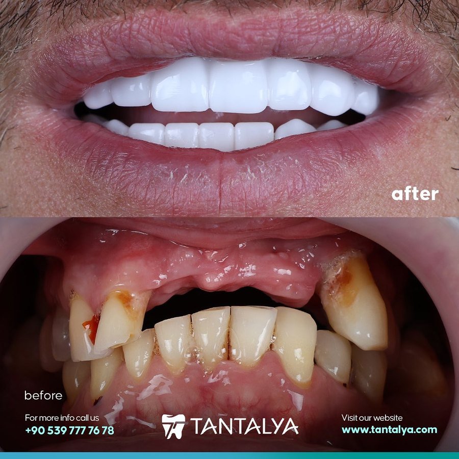 Implant-supported crown and bridge restoration replacing missing front teeth