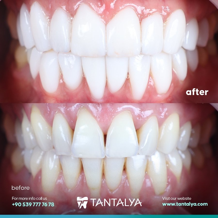E-max porcelain veneers case — full upper arch transformation