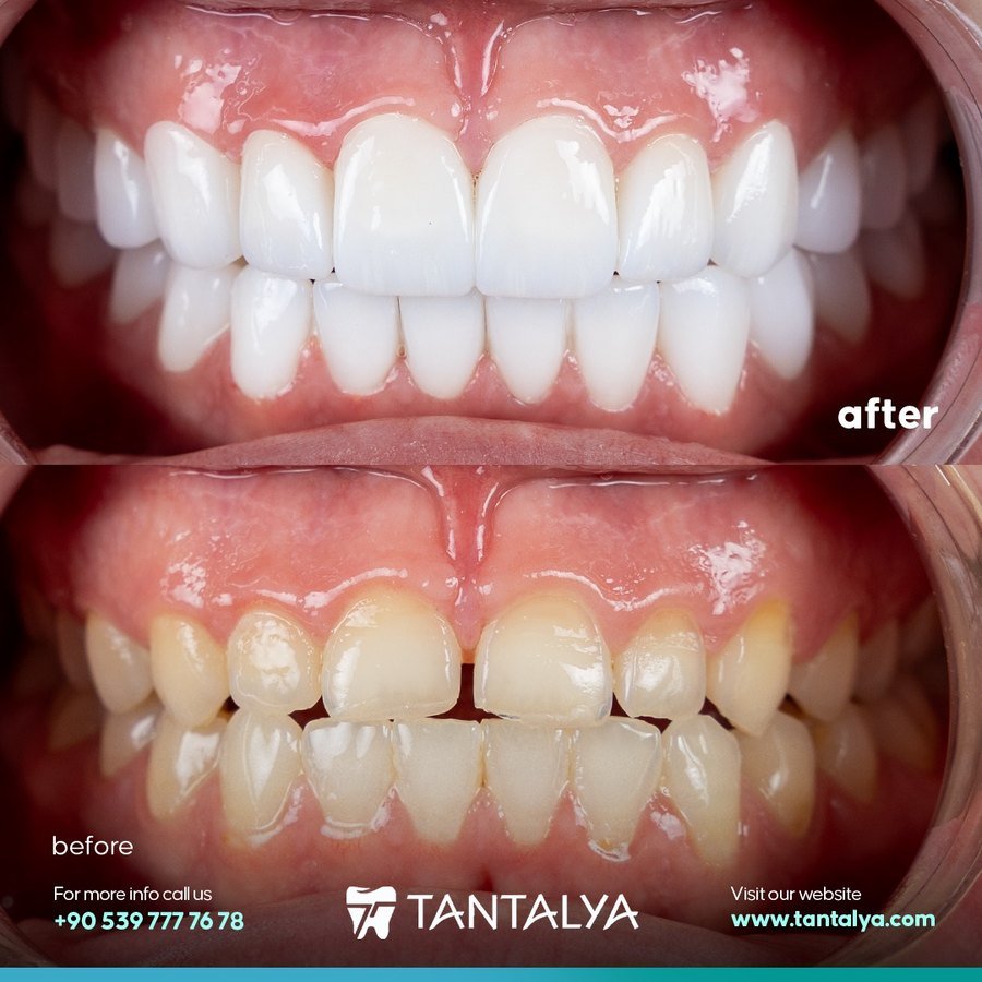 E-max veneers case — diastema closure with full smile reshaping