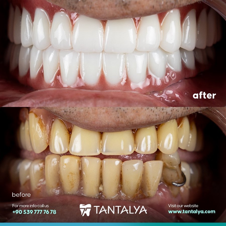 Full mouth rehabilitation — complete smile restoration on aged teeth
