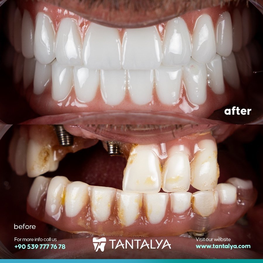 Full arch implant restoration — fixed prosthetic over implant abutments