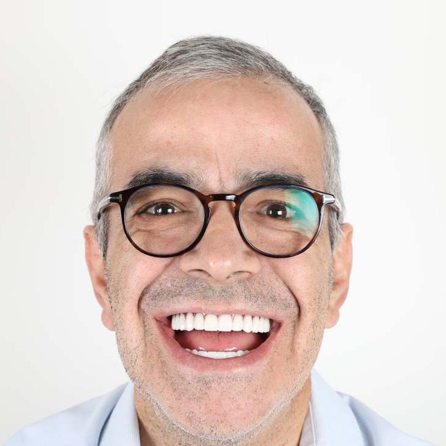 Smile makeover — Efter