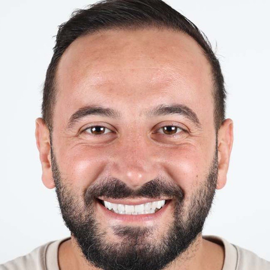Smile makeover — Efter