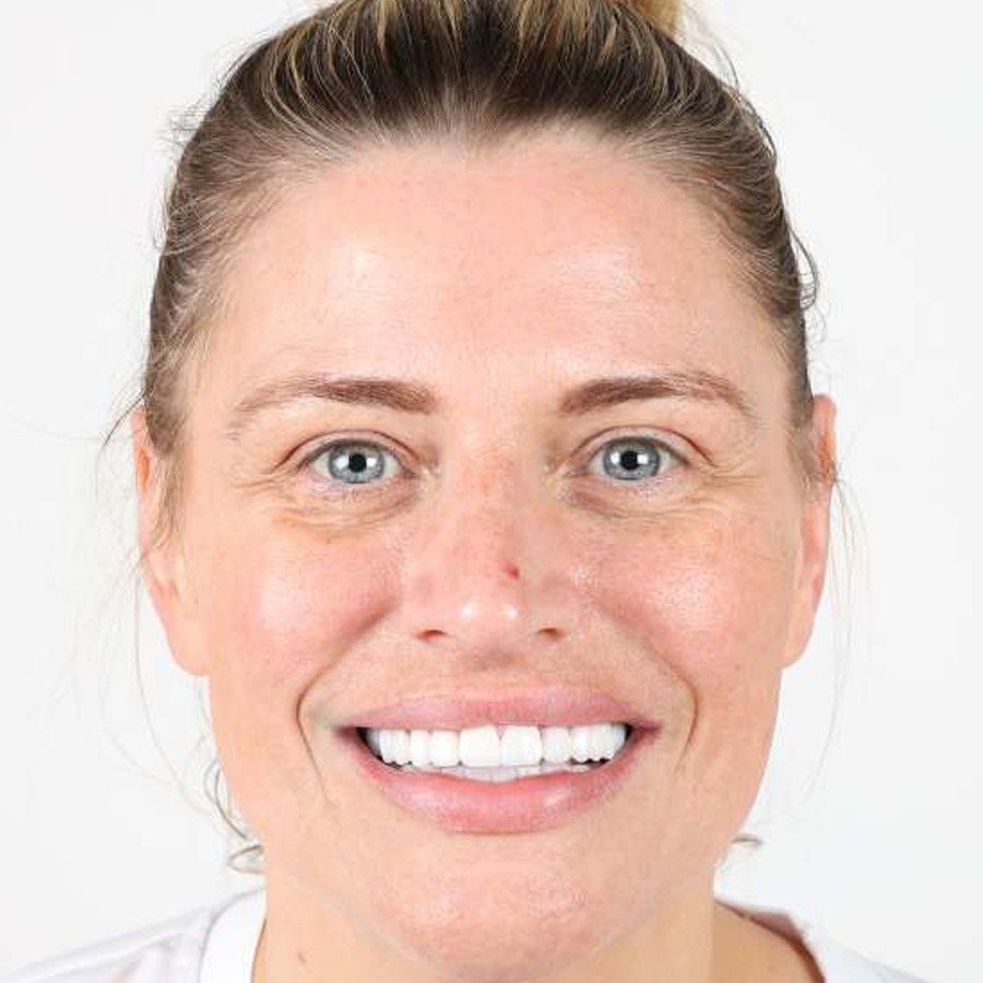 Smile makeover — Efter