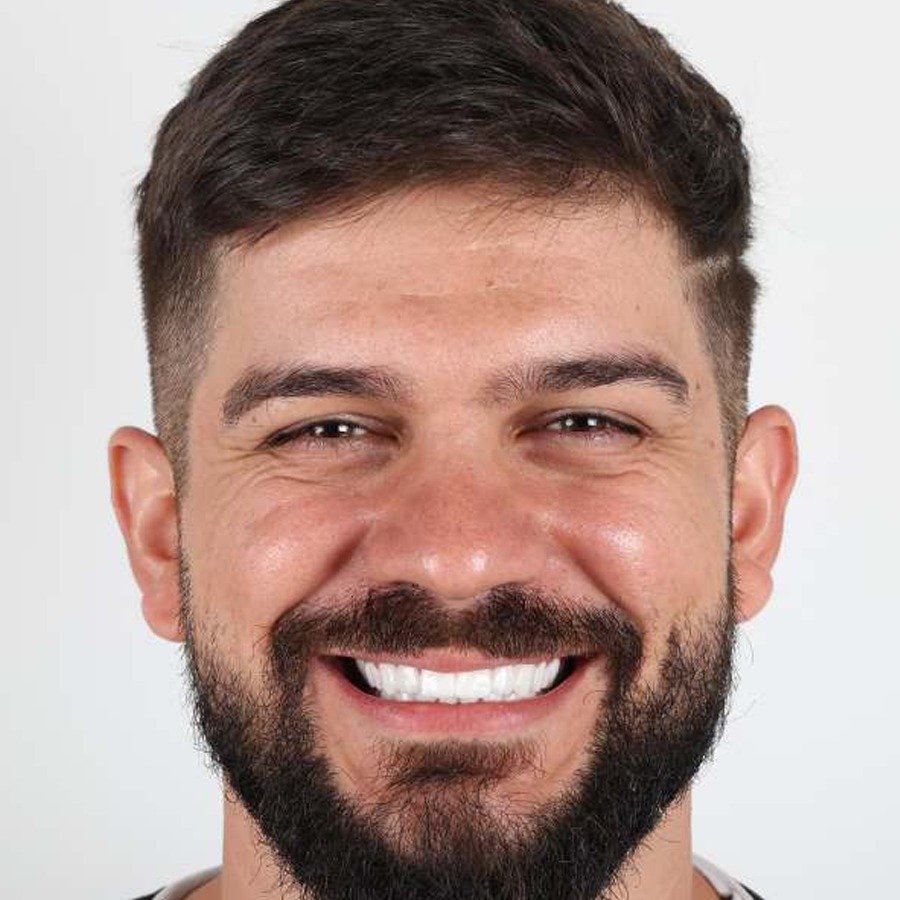 Smile makeover — Efter